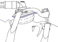 fitting-guide_mirage-activa-lt-8